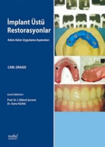 İmplant Üstü Restorasyonlar: Adım Adım Uygulama Aşamaları  Frontansicht 1